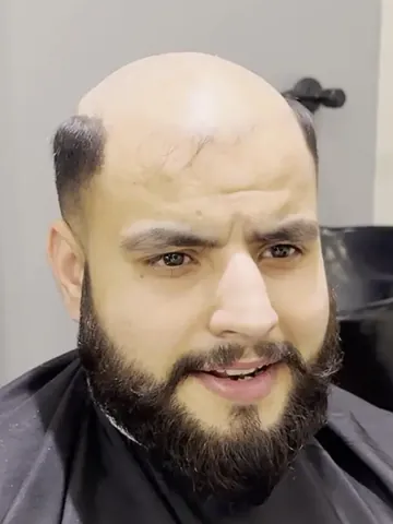 The same client before, with hair loss on top